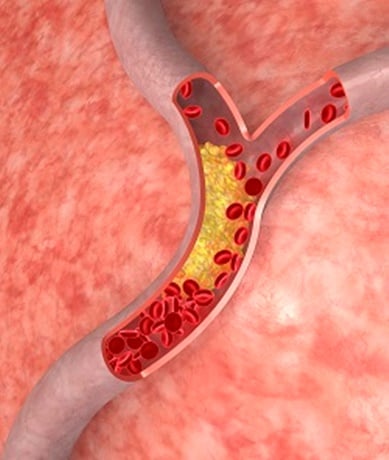 Awas Kolesterol Tinggi Bisa Picu Pemb uluh Darah Rusak Permanen